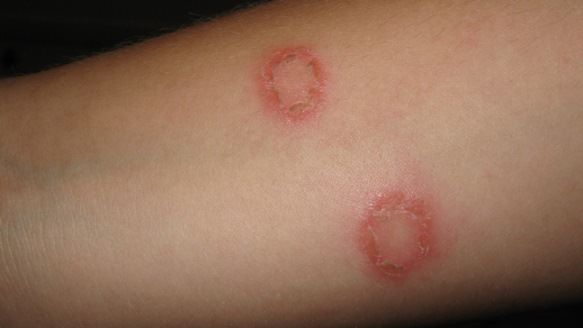 How to Get Rid of Ringworm Naturally?