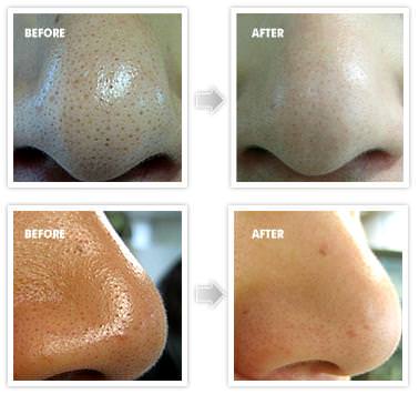 how to get rid of blackheads fast overnight naturally