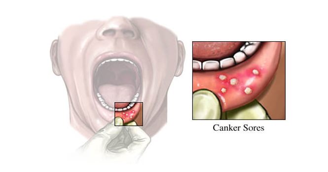 Use Hydrogen Peroxide for Canker Sores