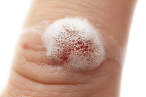 Hydrogen Peroxide Uses for Wound Care