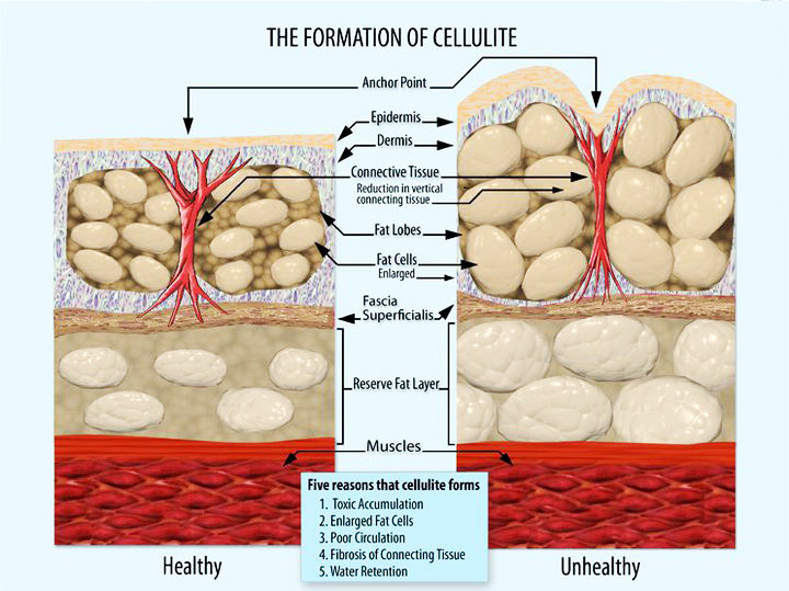 Cause and Formation of Cellulite