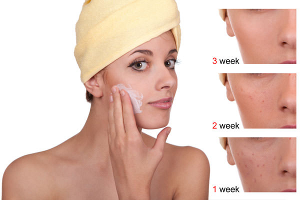 How to Avoid Acne Scars Naturally