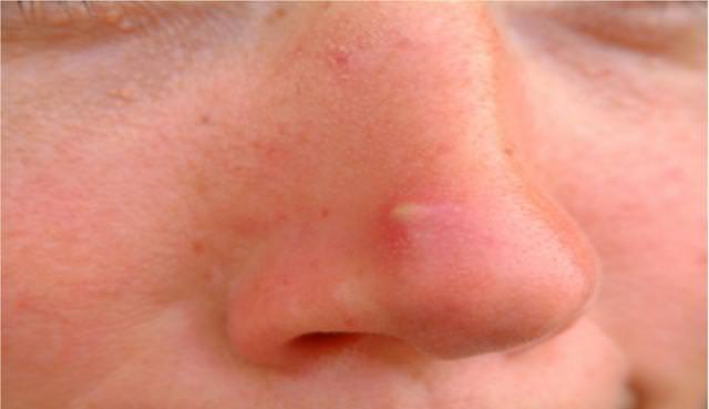 how to get rid of pimples on nose fast and overnight