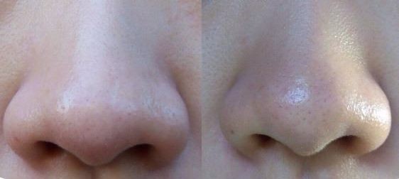 Get Rid of Whiteheads fast from Face Nose Chin