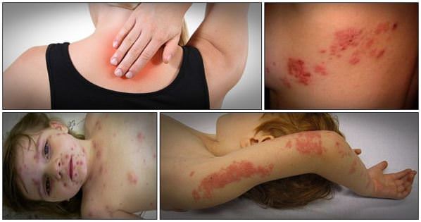 Home Remedies for Shingles Treatment Pain Relief