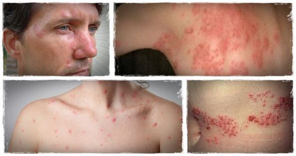 Shingles Treatment Home Remedies for Shingles Pain Relief