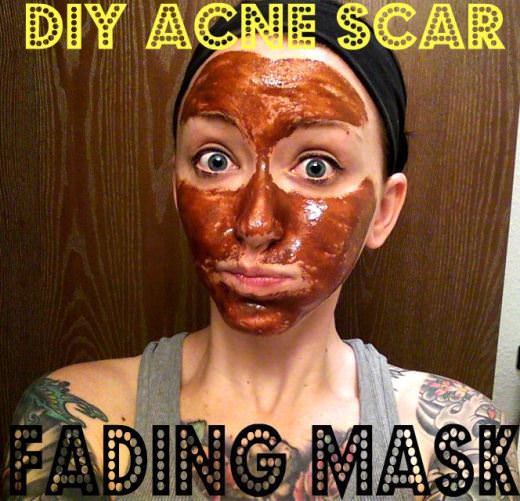Home Remedies to Fade Acne Scars Erase Acne Scars at Home