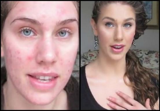how to remove pimple scars get rid of pimple scars