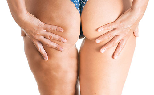 Get Rid of Cellulite Fast and Naturally