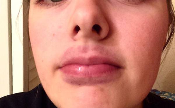 How to get rid of a bruised lip swollen lips