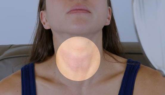 Home Remedies for Goiter Treatment Naturally