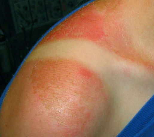 How to Treat a Sunburn and Get Sunburn Relief