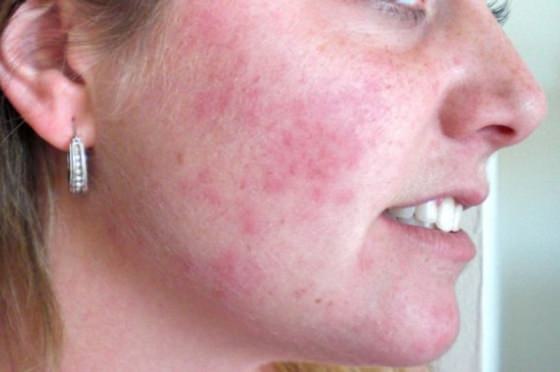 Home Remedies To Treat Rashes On Face