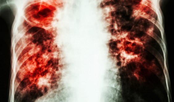 Home Remedies to Treat Pulmonary Fibrosis Disorder