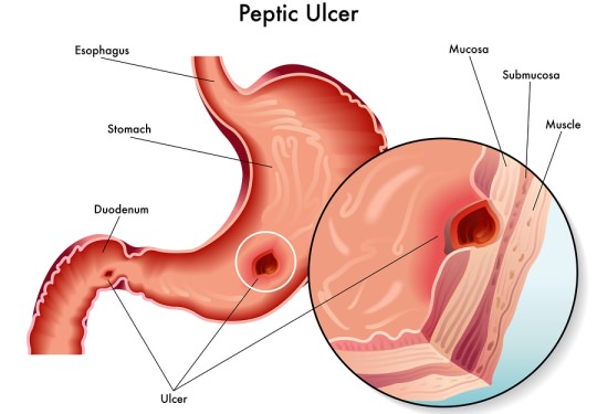 Stomach Ulcer Symptoms How to Check Symptoms of Stomach Ulcer