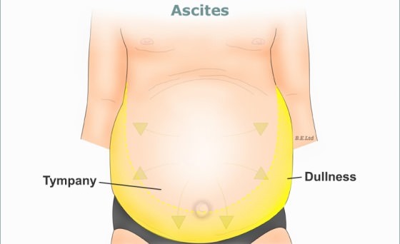 Home Remedies for Ascites Treatment Naturally