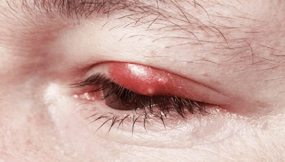 how to get rid of a stye overnight fast naturally