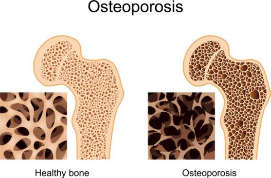 Home Remedies for Osteoporosis Treatment Naturally