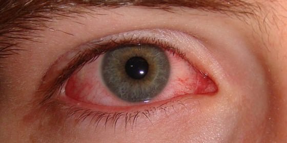 Home Remedies for Red Eye Treatment Naturally