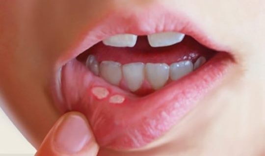 How to Get Rid of Canker Sores Home Remedies