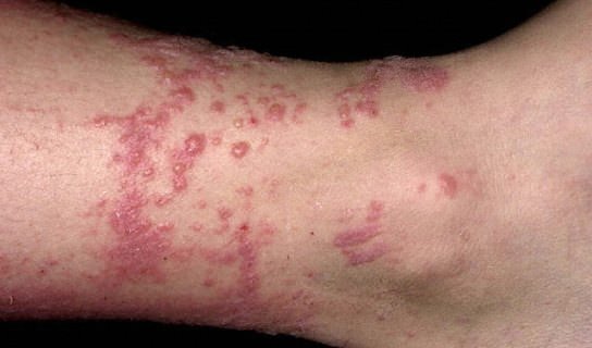 How to Get Rid of Poison Ivy Rashes Fast And Naturally