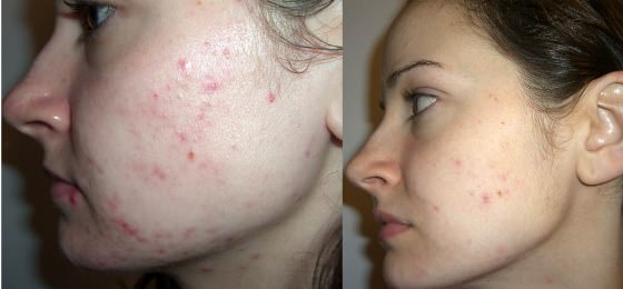 How to get rid of acne in 1 day