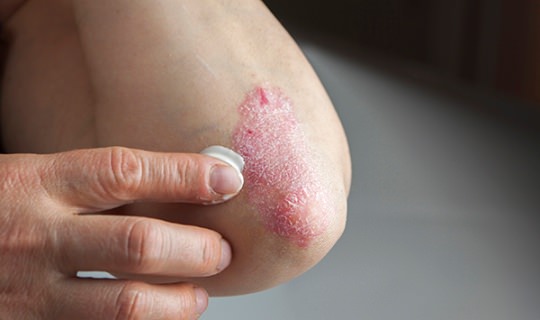 How to treat eczema naturally