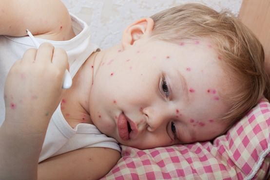 Home Remedies for Chicken Pox Relief Naturally