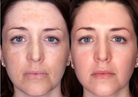 Home Remedies for Melasma Treatment and Cure