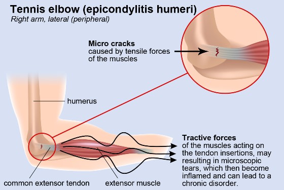 Home Remedies to Cure Tennis Elbow Naturally & Fast