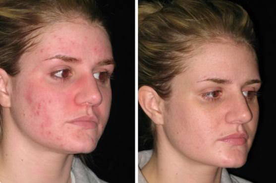 How to Get Rid of Acne Naturally Home Remedies