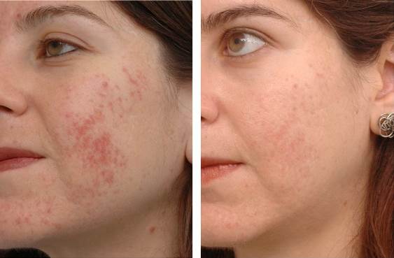Get Rid of Acne Scars With Home Remedies