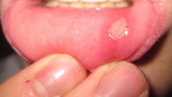 Home Remedies to Get Rid of Canker Sores