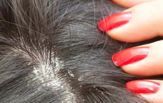 How to Get Rid of Dandruff at Home Home Remedies for Dandruff