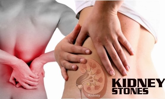 How to Get Rid of Kidney Stones Prevent Kidney Stones