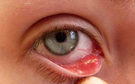 How to Get Rid of Pink Eye Naturally Fast