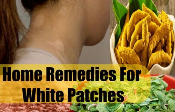 Natural remedies for white patches on skin