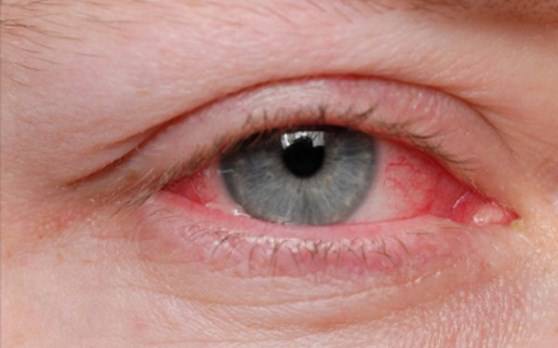 How to Comfort a Sore and Itchy Eye