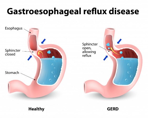 https://lethow.com/wb-content/uploads/2015/08/Home-Remedies-For-Gastro-Esophageal-Reflux-Disease-GERD.jpg