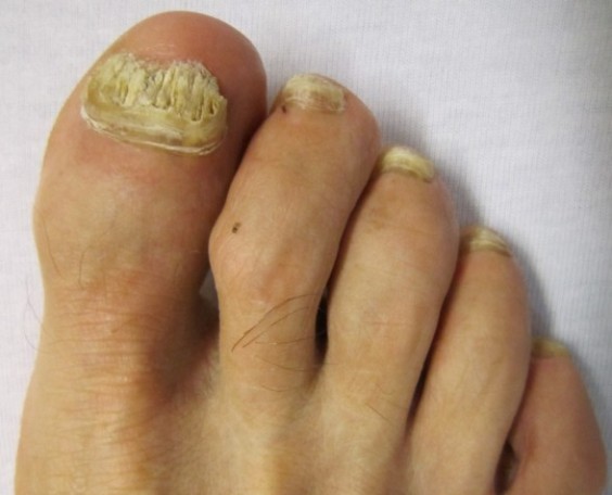 Home remedies for toenail fungus treatment