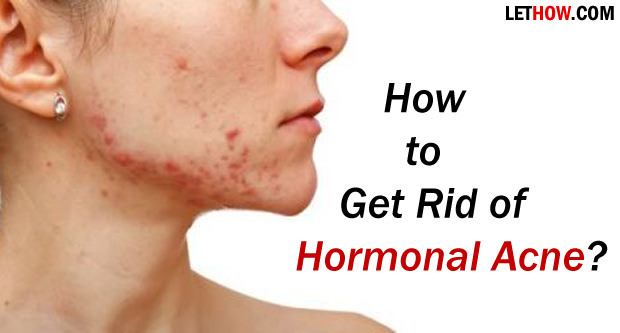 How to Get Rid of Hormonal Acne