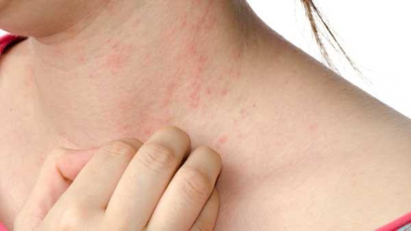 how to get rid of eczema