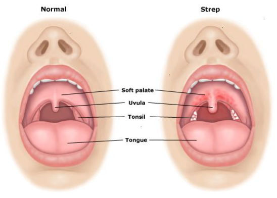 how to treat strep throat