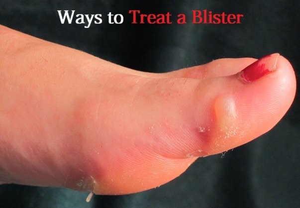 treat a foot blister
