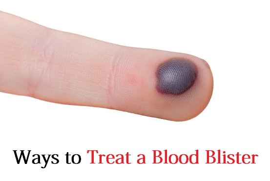 treat a blood blister