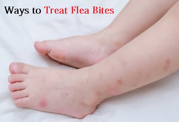 treat flea bites