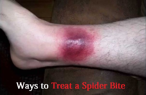 treat a spider bite