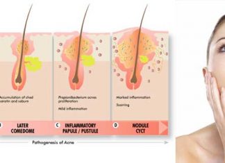 What Is Acne and Causes Acne