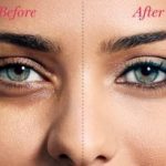 Get rid of dark circles under your eyes fast & permanently