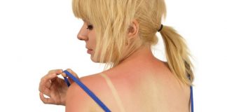 Sunburn Treatment How to Treat Sunburn Skin